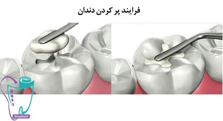 فرایند پر کردن دندان