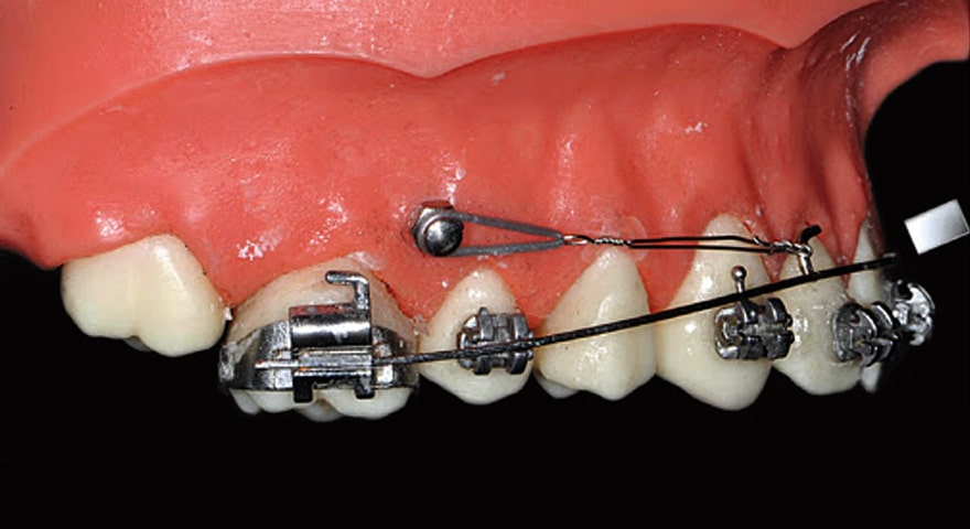 مینی اسکرو در ارتودنسی
