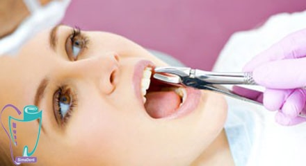 میخواستم بدونم با توجه به اینکه اکثر دندانهای مشکل دارند اگر همه رو بخوام بکشم و به نوعی دندان مصنوعی ثابت یا چیزی شبیه این، راهنمایی بفرمایید، هم نحوه اجرا، هم مدت زمان مورد نیاز و هم هزینه 1 کشیدن دندان