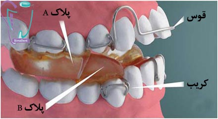 درمان با پلاک دو طرفه