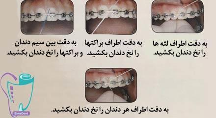 نحوه صحیح استفاده از نخ دندان در حین درمان ارتودنسی