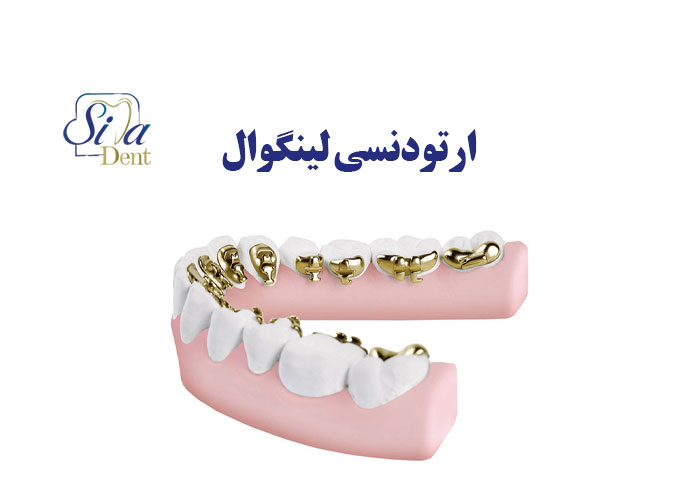 ارتودنسی لینگوال