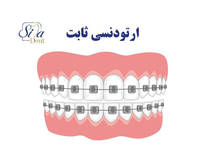 تصویر شاخص مقاله ارتودنسی ثابت