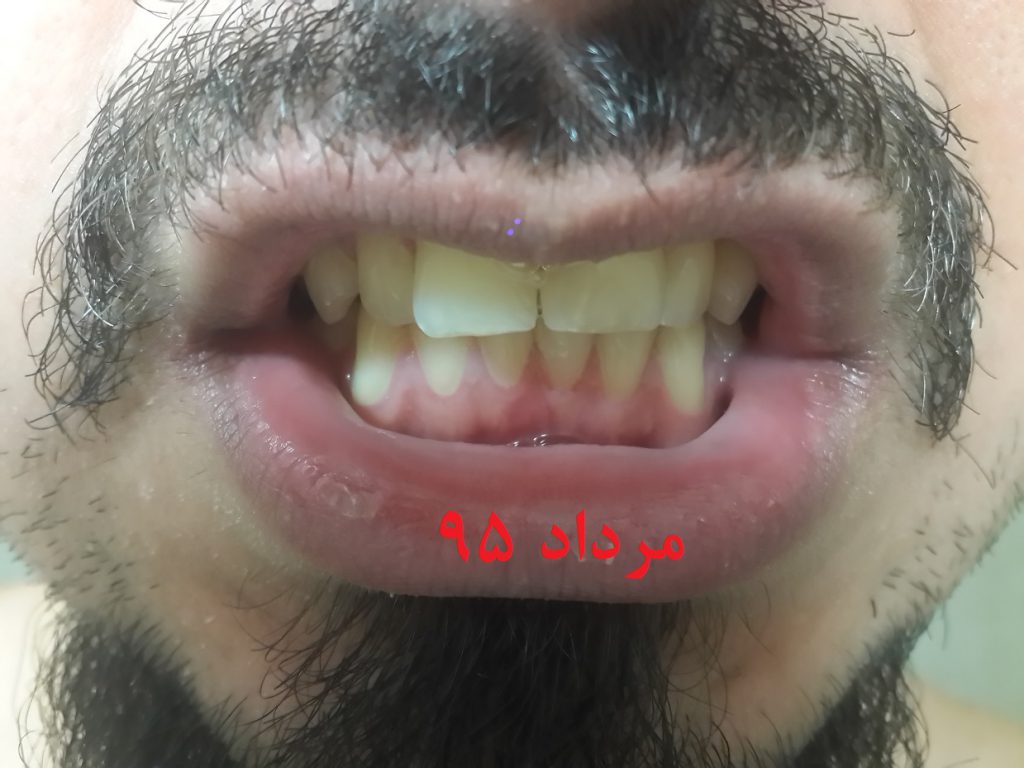 با سلام و احترام در خرداد 95 جهت بستن فاصله بین دو دندان جلو فک بالا به دندان پزشک مراجعه کردم ایشان با استفاده از روش کاپوزیت gap بین دو دندان پر کردن و هیچ فاصله ایی باقی نماند. پس از گذشت چند روز به تدریج بین دندان ها فاصله افتاد، به طوری که الان(گذشت 2 ماه) در حدود 1 تا 2میل بینشون فاصله افتاده، به دکتر مراجعه کردم، گفتن فک بالا داره حالت U شکل می گیره و کار خودشون تایید کردن و گفتن مواد به کار برده شده خیلی مقاومن و به این راحتی نمی ریزن (راستم می گن). من پسری 26 ساله هستم، از دهان نفس نمی کشم، فک پایین 7 میل از فک بالا عقب تر است. تعداد دندان هایم 14+14 = 28 من خودم احساس می کنم فک بالا به سرعت در حاله رشده و باعث شده از فک پایین جلوتر دیده شود. 1- پیشنهاد شما در این شرایط برای بستن مجدد فضا بین 2 دندان جلو چیست ؟ 2- ایا می توان با ارتودنسی (ثابت یا متحرک) در سن 26 سالگی هم فاصله بین دو دندان و هم ناهماهنگی فک ها (7mm) اصلاح کرد. (حتی اگر 2 3 mm هم رفع شود، قابله قبوله) 3- ارتودنسی (ثابت یا متحرک) می تواند جلو رشد بی رویه فک بگیرد ؟ ممنون از پاسخگویی