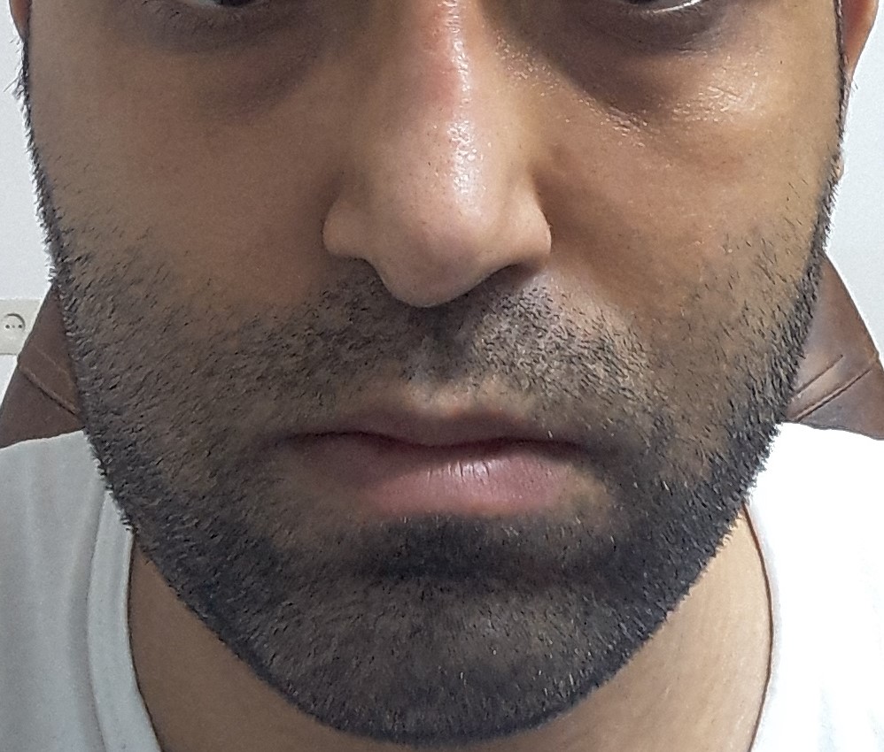 جناب اقای دکترداوودیان با سلام و احترام بنده در کودکی به دلیل سقوط از بلندی دچار ضربه به ناحیه صورت و فک شده بودم. به همین دلیل انحراف واضح در سپتوم بینی و نیز انحراف مختصر رشد فک بالایی به سمت راست و به تبع ان انحراف لب ها به اندازه حدود 5 میلی متر دارم. انحراف بینی را سال هاپیش جراحی کرده ام. فک ها کاملا به صورت صحیح جفت می شوند و 2 دندانپزشک عمومی که از دوستان بودند معاینه کرده و گفتند که مشکل خاصی در دندان ها و نیز فک ها وجود ندارد. خواهشمندم بفرمایید آیا این میزان انحراف لب نیاز به جراحی دارد و در صورت جراحی دوره نقاهت آن حدودا چه مدت است؟ 1 جناب اقای دکترداوودیان با سلام و احترام بنده در کودکی به دلیل سقوط از بلندی دچار ضربه به ناحیه صورت و فک شده بودم. به همین دلیل انحراف واضح در سپتوم بینی و نیز انحراف مختصر رشد فک بالایی به سمت راست و به تبع ان انحراف لب ها به اندازه حدود 5 میلی متر دارم. انحراف بینی را سال هاپیش جراحی کرده ام. فک ها کاملا به صورت صحیح جفت می شوند و 2 دندانپزشک عمومی که از دوستان بودند معاینه کرده و گفتند که مشکل خاصی در دندان ها و نیز فک ها وجود ندارد. خواهشمندم بفرمایید آیا این میزان انحراف لب نیاز به جراحی دارد و در صورت جراحی دوره نقاهت آن حدودا چه مدت است؟