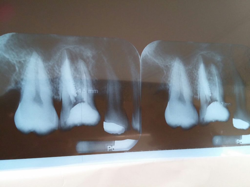 با سلام دکتر داوودیان حدود یک ماه پیش جهت عصب کشی رفتم و عصب کشی در سه مرحله صورت گرفت و دکتر دندانپزشک موفق به دراوردن پین دندان نشد نظر دکتر کشیدن دندان و انجام ایمپلنت است. به نظر شما با وجود این شرایط آیا پر کردن دندان کار درستی است؟ پیشنهاد شما در این خصوص چیست؟ با تشکر