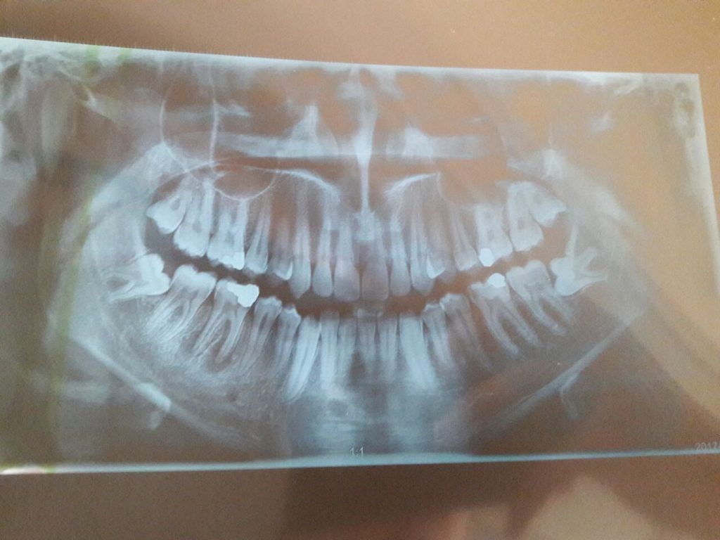 با توجه به عفونت دندان 6 یک پایین راست آیا قابل ترمیم هست یا باید کنده بشود ؟ اگر امکان دارد هزینه را حدودا مشخص فرمائید.
