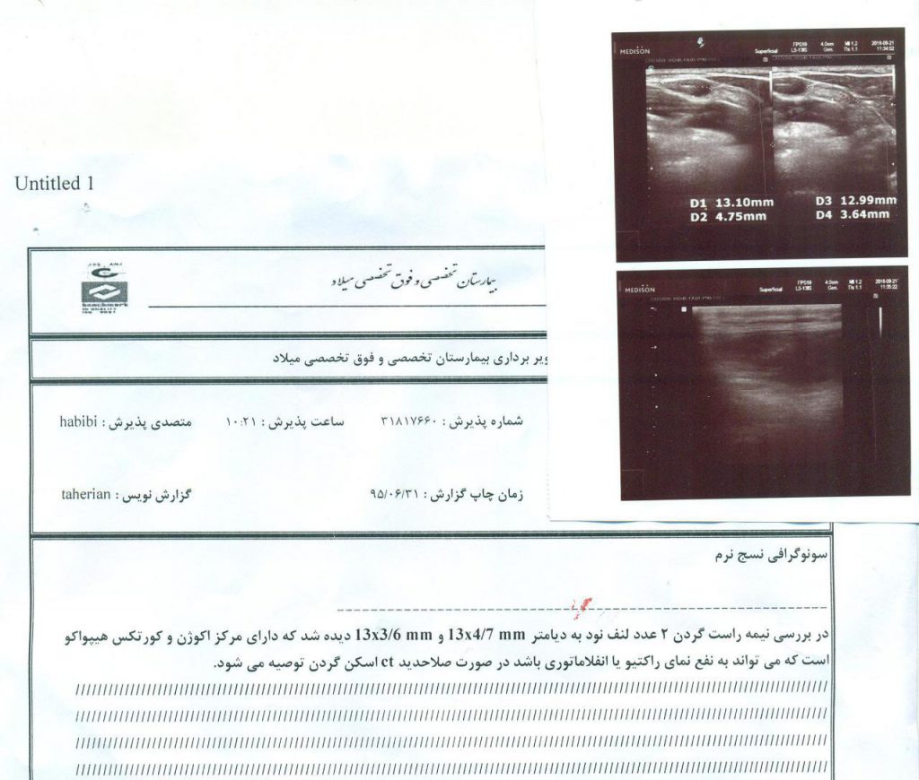 حدود سه ماه میباشد که یک توده در سمت راست گردن بنده ایجاد شده البته درد ندارد و فقط سه روز بعد از FNA دردناک شده بود. حضور حضرتعالی عر ض میشود که حدود ده سال پیش در قسمت دو طرف فک بالا برای جایگزینی فضای خالی ناشی از کشیدن دندانها از بریج استفاده شده است که حدوداً مدت دو سال است که بنده در دهان خود احساس ترشحات چرکین میکنم . قبلا از راهنمایی و تشخیص حضرتعالی کمال تشکر و امتنان را دارم ارادتمند کریم زاده