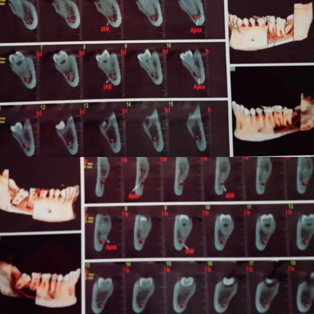 سلام دکترداوودیان می خواستم این گزارش CBCT را برایم تفسیر کنید و آیا نیازی به جراحی هست یا نه و اگر جراحی انجام شود آیا عوارض بی حسی زبان یا لب اتفاق می افتد؟ با توجه به این که دندان آسیای سمت چپ در تماس با عقل کمی پوسیدگی پیدا کرده است. احتراما در کلیشه تهیه شده از بیمار در خصوص دندان شماره ۸ چپ این دندان به صورت نهفته و دیستوانگولار قرار گرفته است. این دندان به صورت دو ریشه قابل مشاهده می باشد و IAN در موقعیت لینگوال در تماس با اپکس قرار دارد. در خصوص دندان شماره ۸ راست این دندان به صورت نهفته و مزیوانگولار قرار دارد. کانال IAN به صورت مماس در موقعیت لینگوال نسبت به اپکس قرار دارد. مرسی