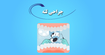 جراحی لثه