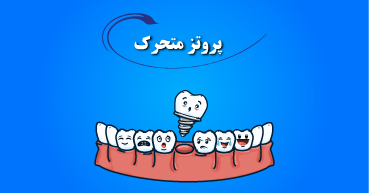 پروتز متحرک