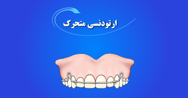 ارتودنسی متحرک