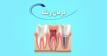 درمان ریشه