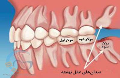 سلام ایا دندون عقل نهفته حتما باید خارج شود؟؟ 1 سلام ایا دندون عقل نهفته حتما باید خارج شود؟؟