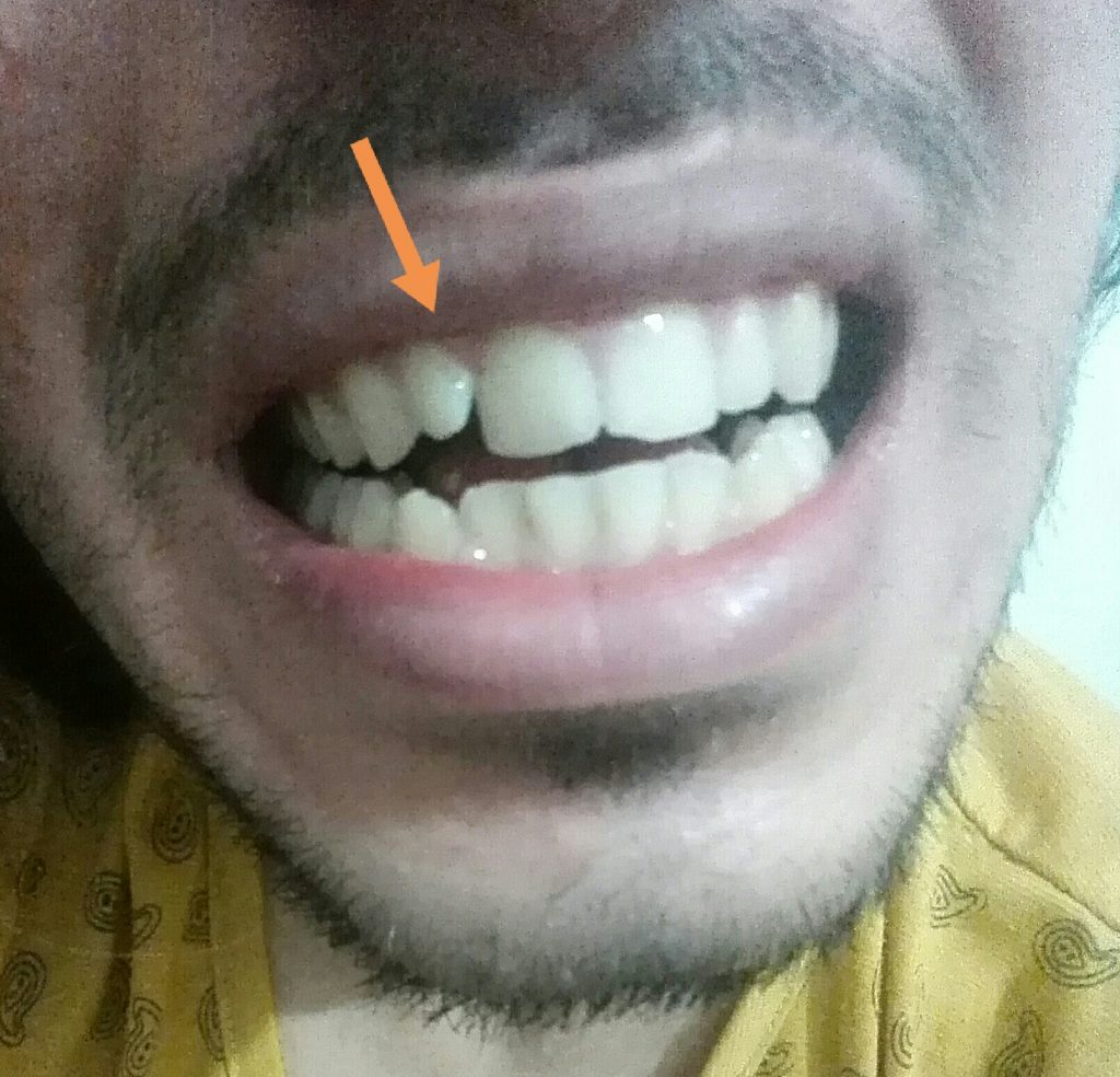حداکثر و حداقل هزینه ارتودنسی دندان های من چقد میشه, با توجه به اینکه فقط دو تا از دندان های فک بالایی منحرف هستند