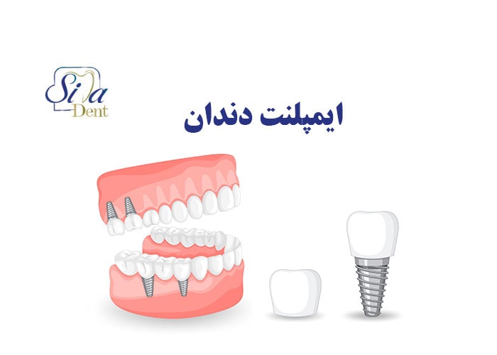 ایمپلنت دندان بهترین روش کاشت دندان
