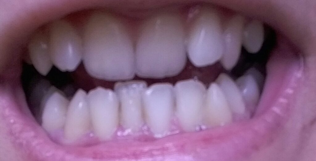 سلام،وقت بخیر. من از شهرستان کلاردشت مزاحم میشم. فاصله ما با تهران دو ساعت و خورده ای هست و میخوام درمان ارتودونسی ترجیحا تهران و توسط دکتر داوودیان انجام بشه. اگر میشه هزینه ی تقریبی دندان بنده رو بصورت ثابت و دیمون رو لطف کنید و بهم بگید. و اینکه اگر از عکس مشخص هست لطفا بفرمایید که کدام روش بهتر هست. عجب یا جلو بودن فک هم ندارم. متاسفانه در شهرستان ما مرکزی برای عکس گرفتن وجود نداره و به دلیل محدودیت های رفت و آمد از شهری به شهر دیگر در مازندران با گوشی عکس گرفتم امیدوارم مناسب باشه. سپاس از شما🌹🌷