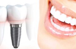 برای پیدا کردن بهترین متخصص ایمپلنت دقت زیادی خرج کنید