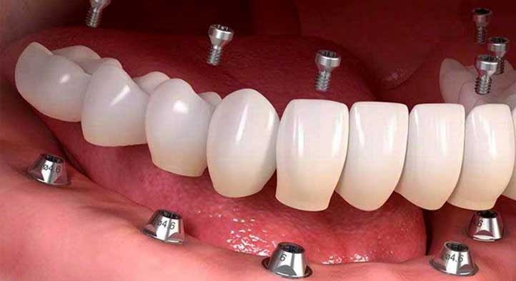 براتر استفاده از موا د مخدر صنعتی ی دفعه تمام دندونام ریخت هزینه کاشت دندون ثابت برام زیاده و در توانم نیست ایا امکان اینکه دندون مصنوعی رو ثابت بکنید هست یا نه ممنون از زحماتتون 1 شما هم به دنبال بهترین متخصص ایمپلنت می گردید؟
