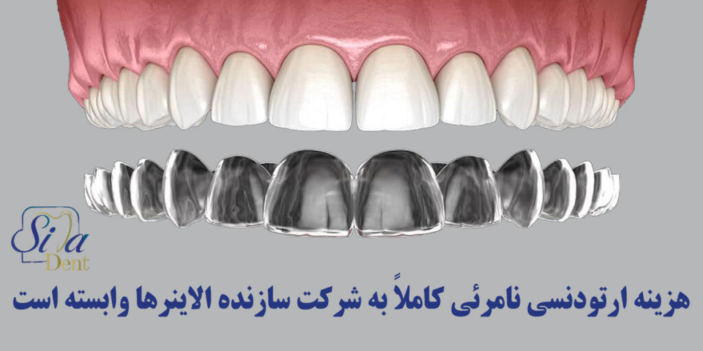 هزینه ارتودنسی نامرئی