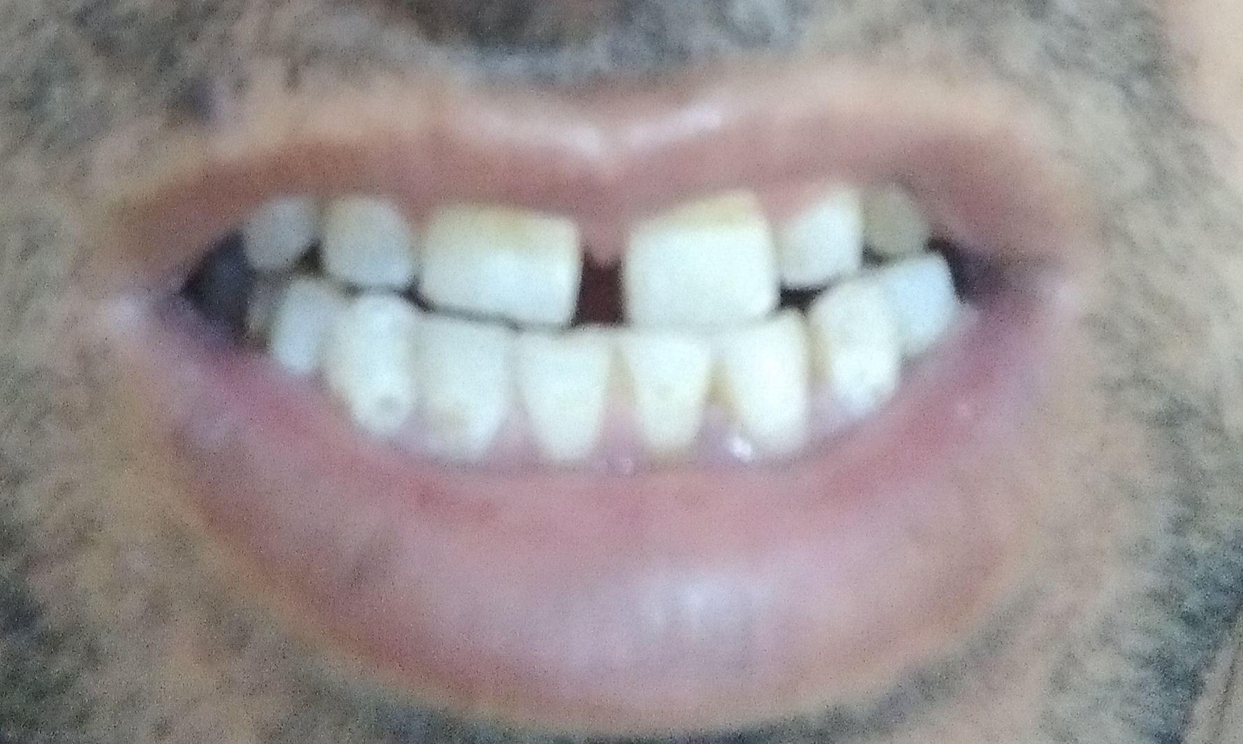 سلام.. من فاصله بین دو دندان جلو دارم.. ولی اصلا ارتوندسنی نمیتونم انجام بدم یه حالت حساسیت و... چه راه دیگری میشه و هزینش چند میشه 1 سلام.. من فاصله بین دو دندان جلو دارم.. ولی اصلا ارتوندسنی نمیتونم انجام بدم یه حالت حساسیت و... چه راه دیگری میشه و هزینش چند میشه