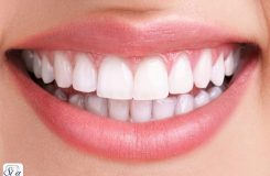 لمینت دندان خرگوشی2