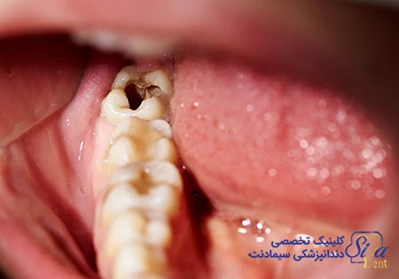 عفونت دندان