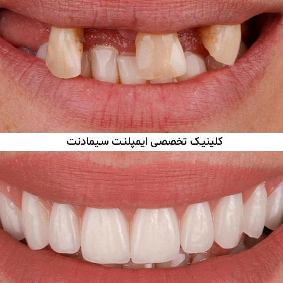 عکس قبل و بعد ایمپلنت دندان