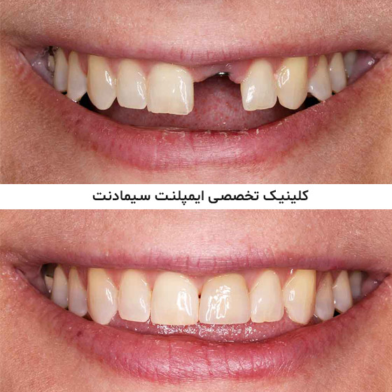 قبل و بعد از ایمپلنت دندان جلو