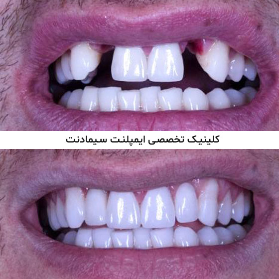 ایمپلنت دندان توسط متخصص ایمپلنت