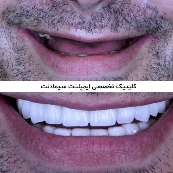 قبل و بعد از ایمپلنت دندان