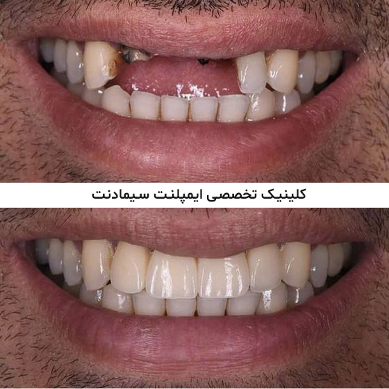 نتیجه کار متخصص ایمپلنت قبل و بعد از ایمپلنت دندان