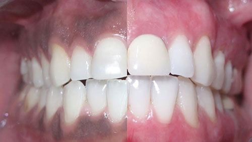 جراحی زیبایی لثه برای رفع سیاهی و تیرگی لثه