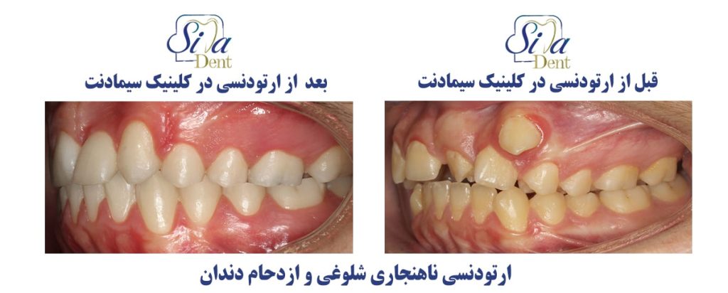 ارتوددنسی بیماری با شلوغی دندان ها