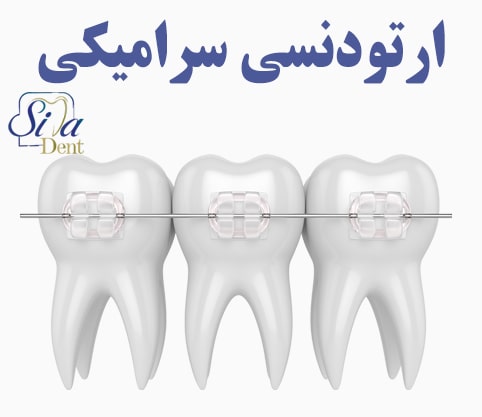ارتودنسی سرامیکی با براکت های هم رنگ دندان
