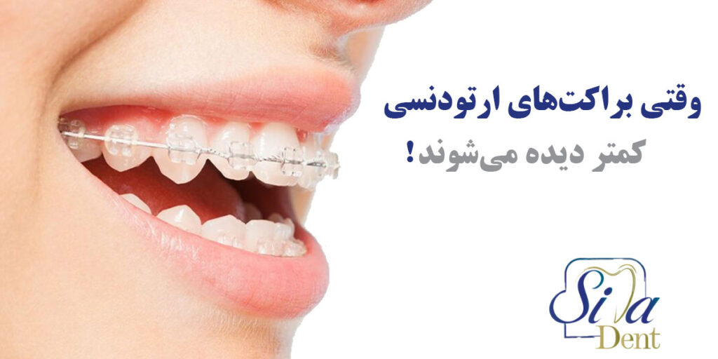 وقتی از ارتودنسی سرامیکی استفاده می شود کمتر به چشم می آید!