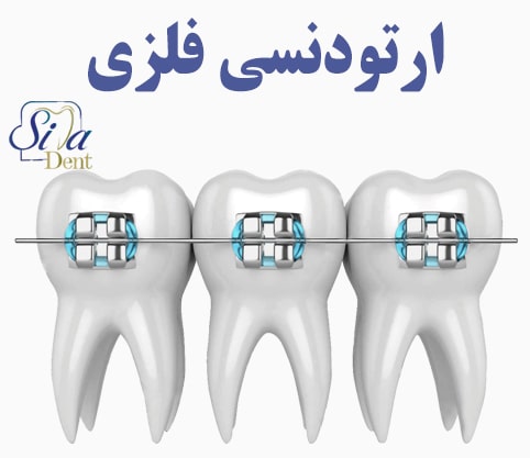 ارتودنسی با براکت های فلزی