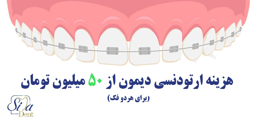 هزینه ارتودنسی دیمون