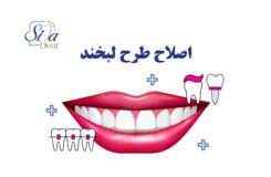 اصلاح طرح لبخند