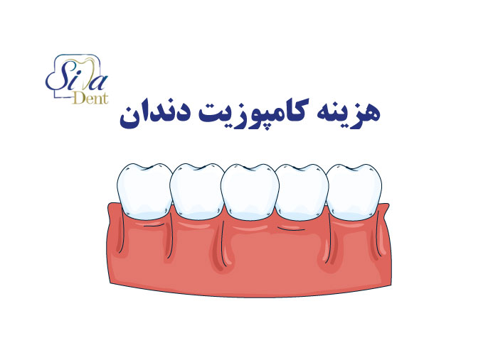 قیمت و هزینه کامپوزیت دندان