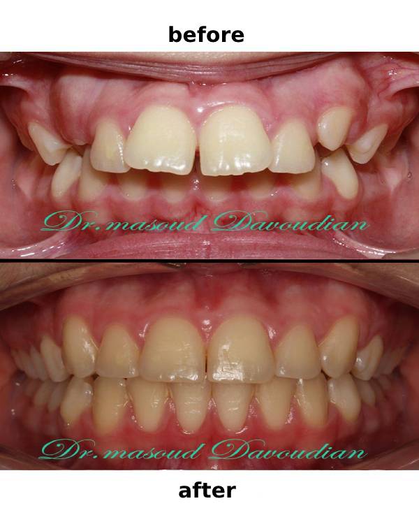قبل و بعد از ارتودنسی | تصاویر + ویدئو