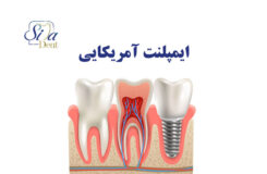 ایمپلنت آمریکایی