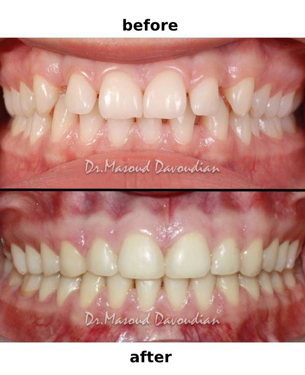 قبل و بعد از ارتودنسی | تصاویر + ویدئو