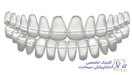 ارتودنسی ثابت سرامیکی