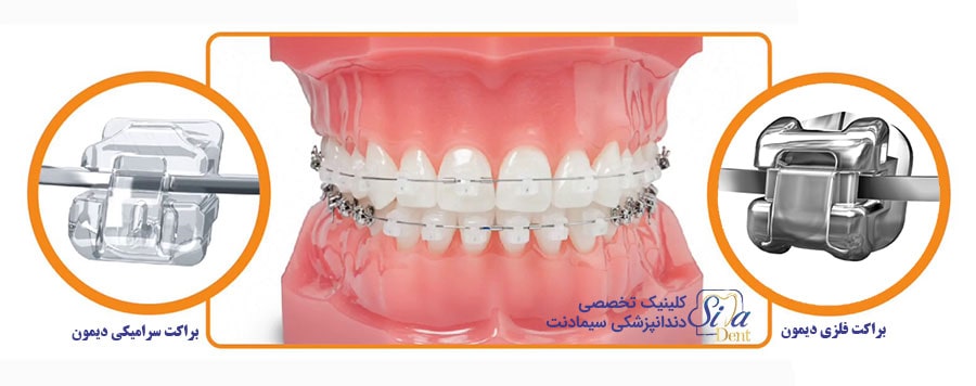 ارتودنسی دیمون سرامیکی (شفاف) و فلزی
