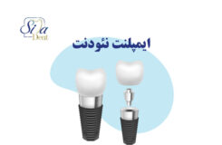 ایمپلنت نئودنت