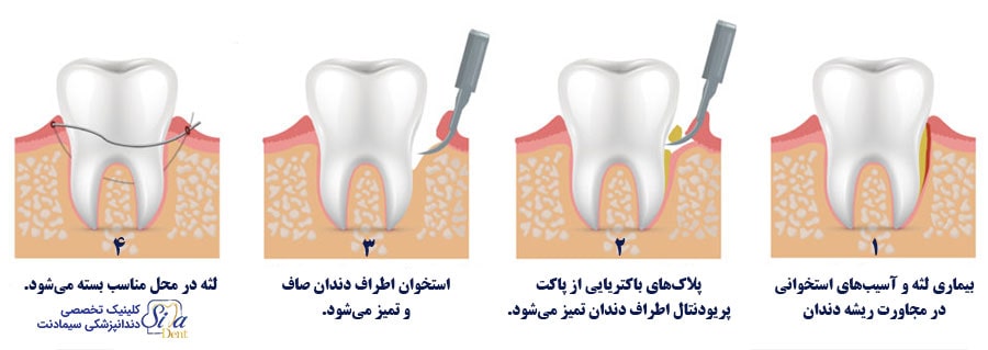 جراحی لثه (جراحی فلپ)