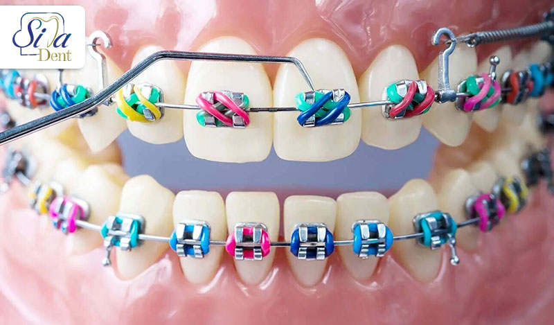 orthodontic-treatment-irregular-teeth