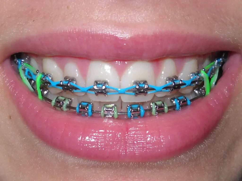 Orthodontic elastics