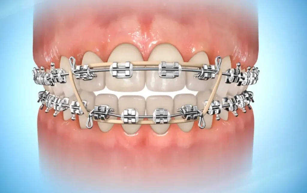 Orthodontic elastics simadent